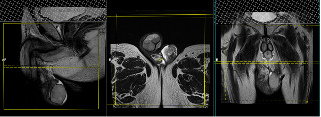 MRI testis axial scan planning image