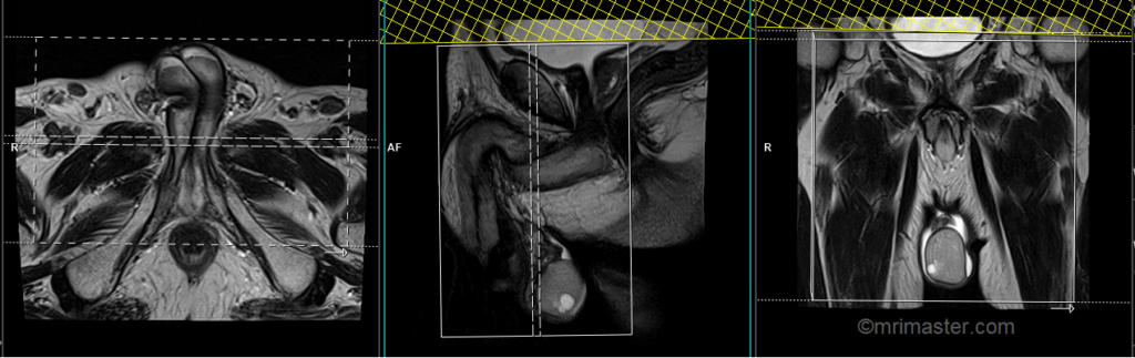 mri testis coronal scan planning image