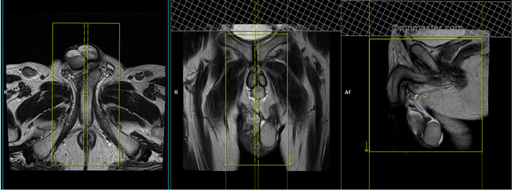 mri testis sagittal scan planning image
