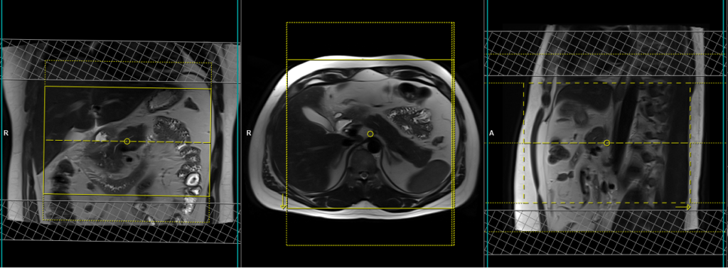 pancreas mri scan planning and protocol of axial image