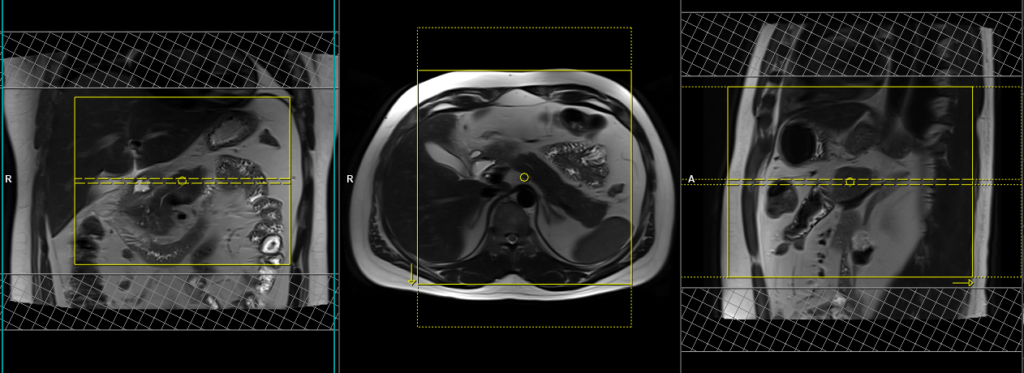 pancreas mri scan planning and protocol of axial t2 image