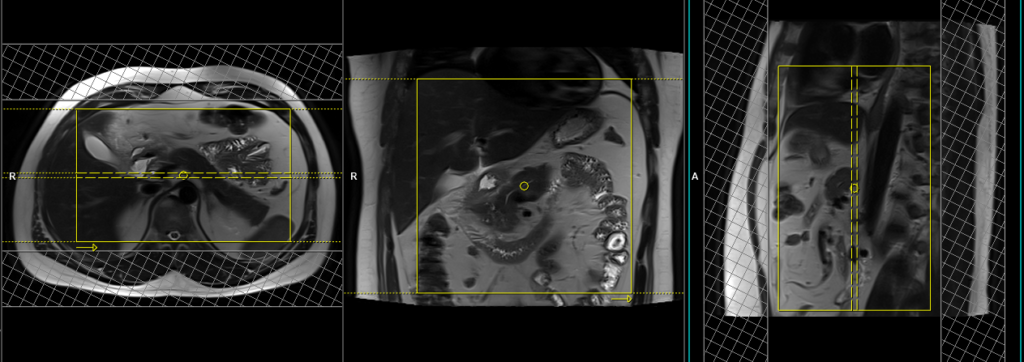 pancreas mri scan planning and protocol of coronal images