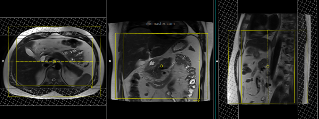 pancreas mri scan planning and protocol of coronal images