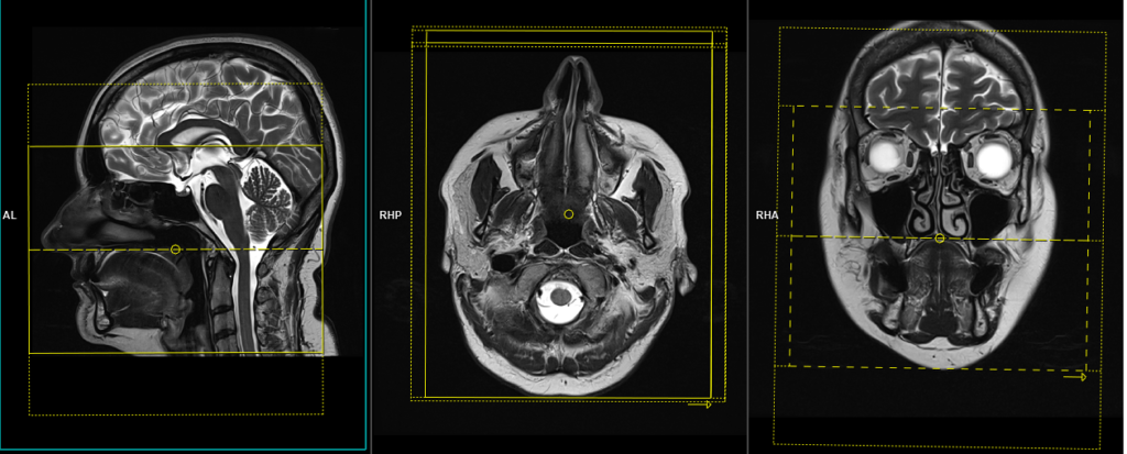 planning of MRI face axial 3D scans