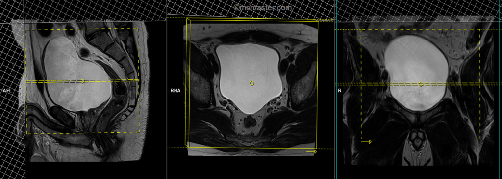urinary bladder mri axial acan planning
