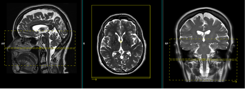 temporomandibular joint(TMJ) MRI axial T2 planning image
