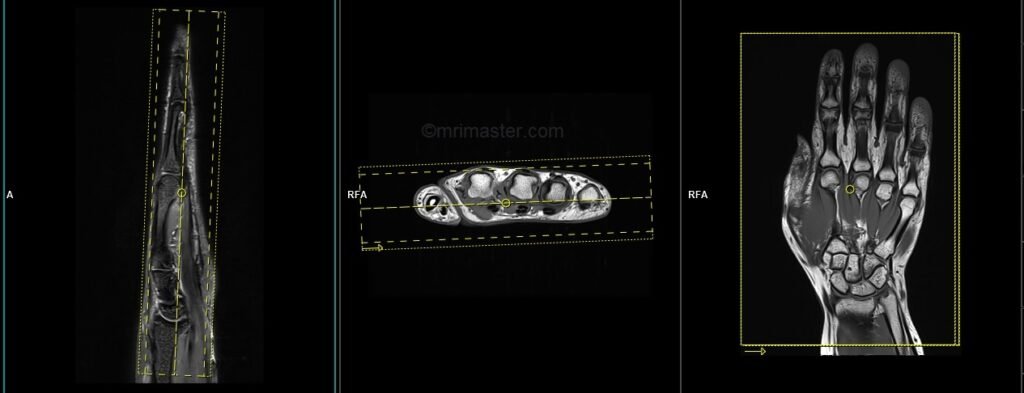 MRA hand dynamic protocol and planning of coronal scans
