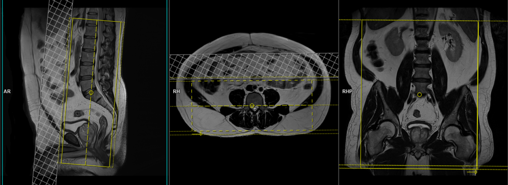 MRI lumbosacral plexus coronal 3d scan planning