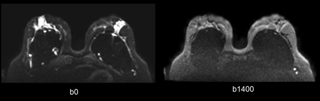 ZOOMit DWI breast images