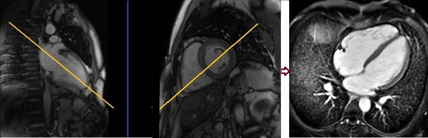 cardiac mri planning 4 chamber post contrast