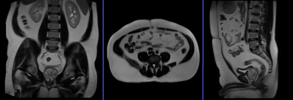 lumbar pluxues MRI localiser image