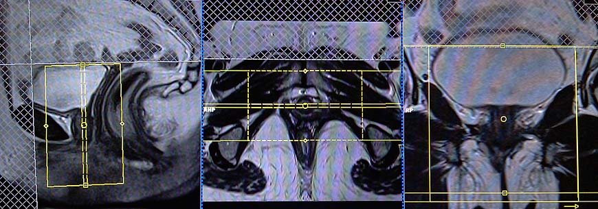mri female urethra t2 coronal small fov image