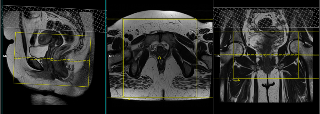 mri pelivis fistula axial planning