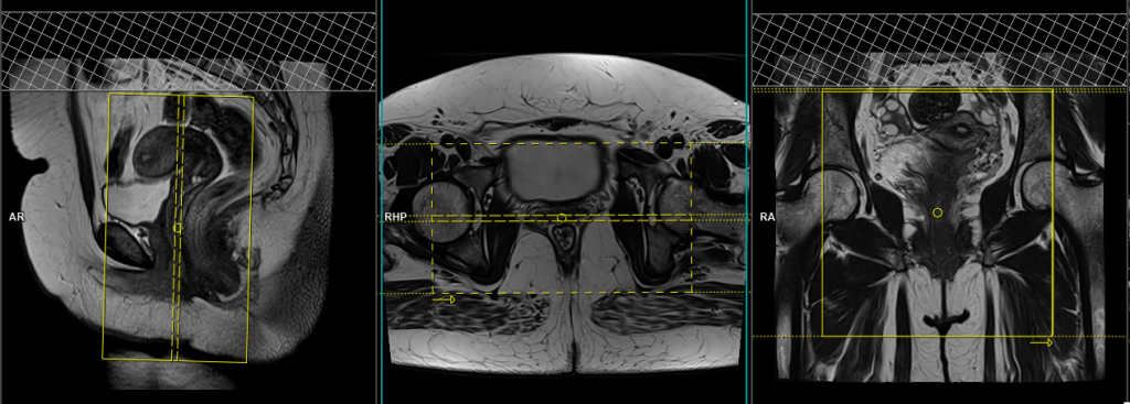 mri pelivis fistula coronal planning