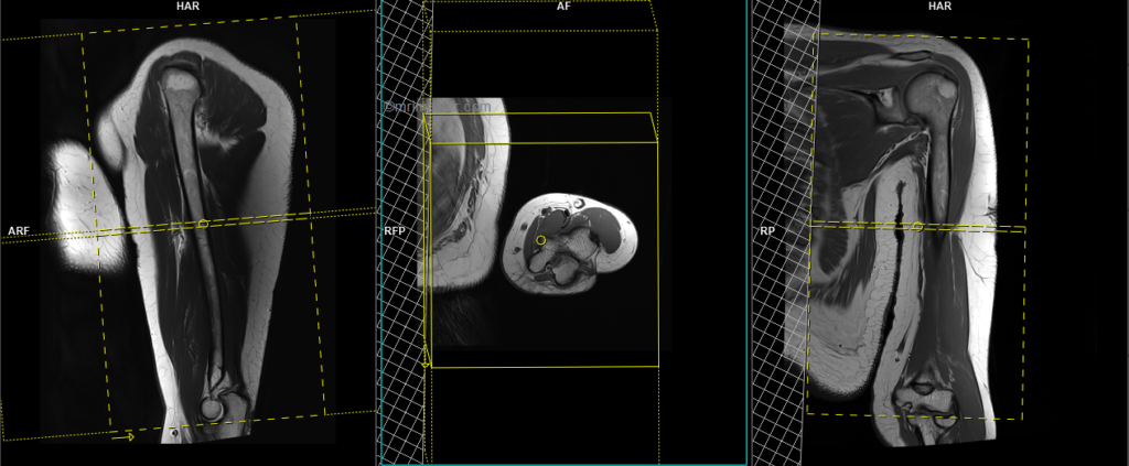 mri upper arm (humerus) axial image planning