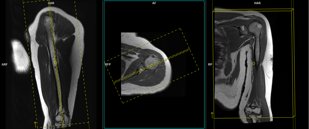 mri upper arm (humerus) coronal image planning
