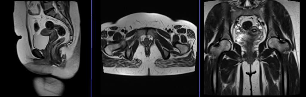 pelvis RV fistula localizer image