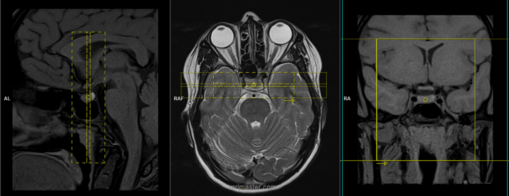 pituitary fossa mri sagittal planing
