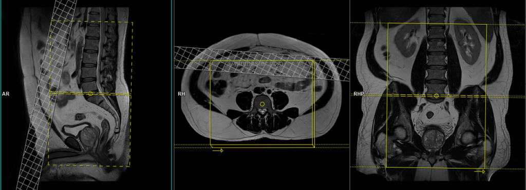 planning mri lumbosacral plexus axial scans