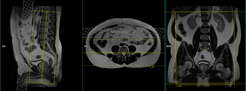 planning mri lumbosacral plexus coronal scans