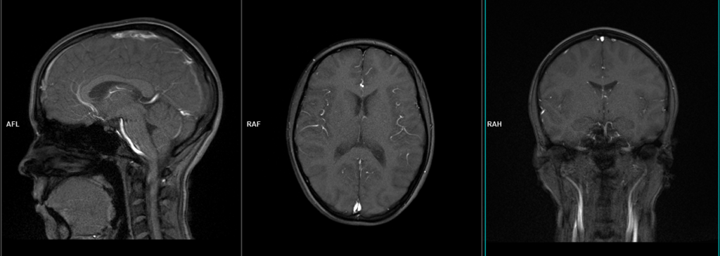 Brain MRV localiser image
