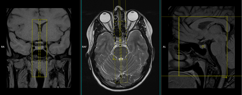 pituitary fossa mri sagittal planing