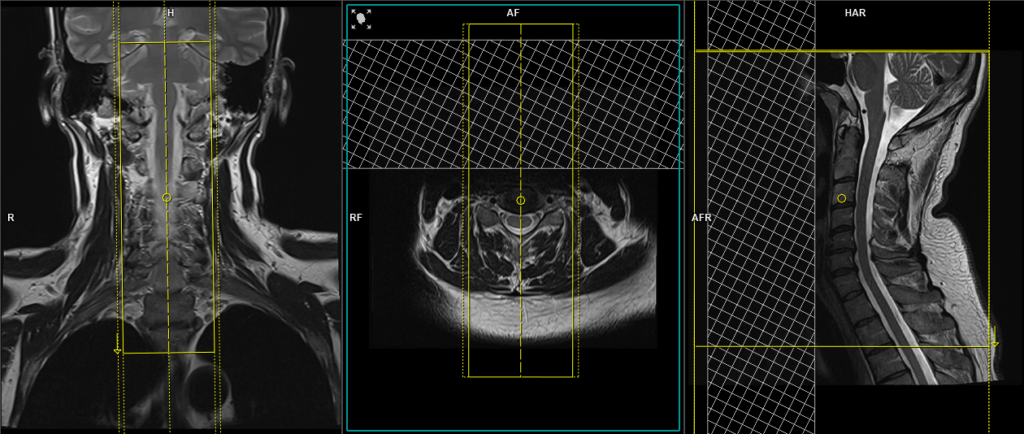 mri Cervical Spine CSF leak protocol sagittal T2 SPACE 3D planning and protocol image