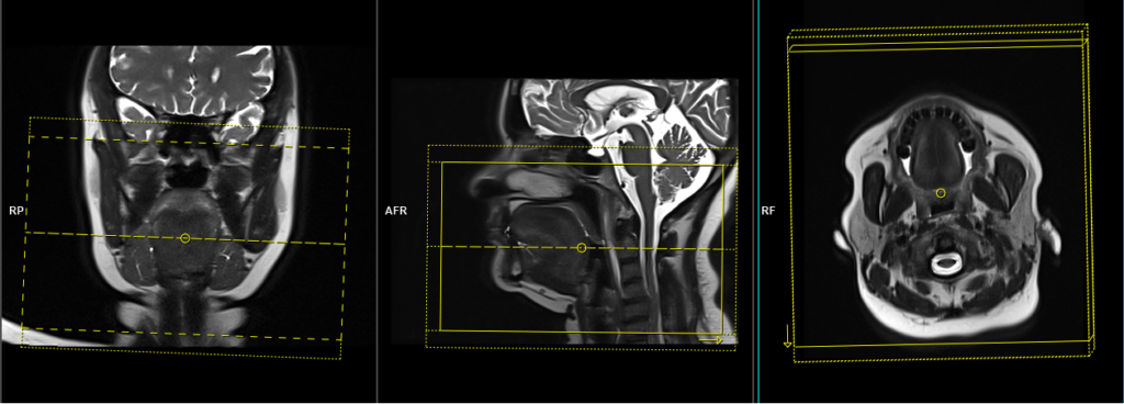 MRI submandibular sialography axial STIR SPACE 3D planning and protocol