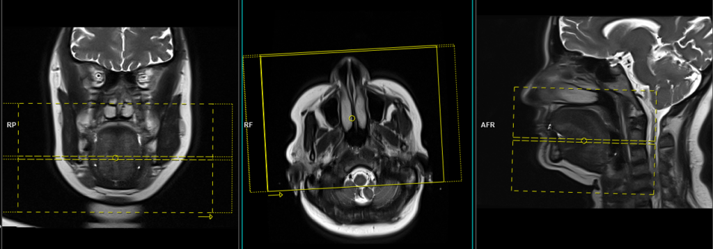 MRI submandibular sialography axial T2 HASTE planning