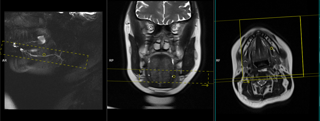 MRI submandibular sialography axial small fov haste scan protocol and planning for 15 mm scan