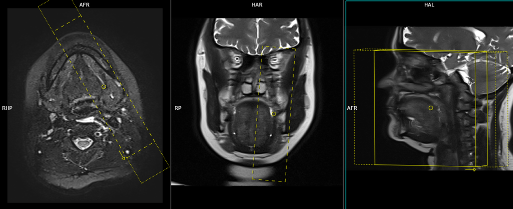 MRI submandibular sialography sagittal T2 SPACE planning