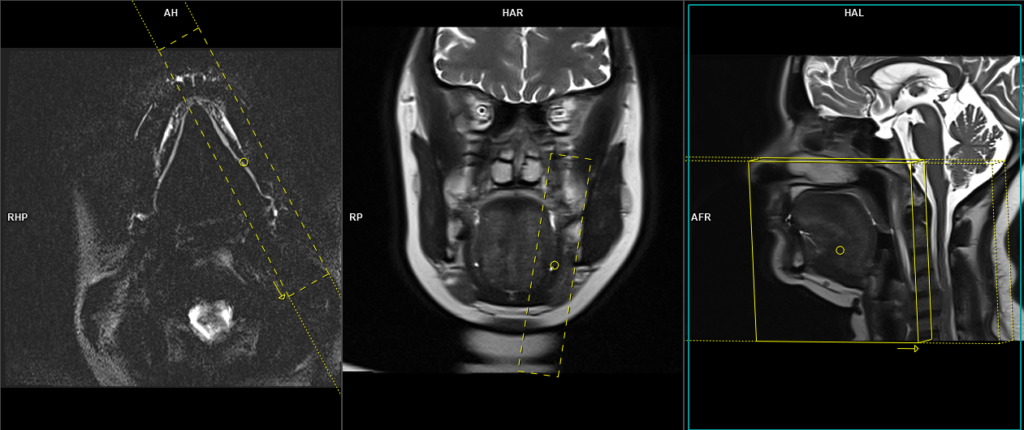 MRI submandibular sialography sagittal haste scan protocol and planning for 15 mm scan