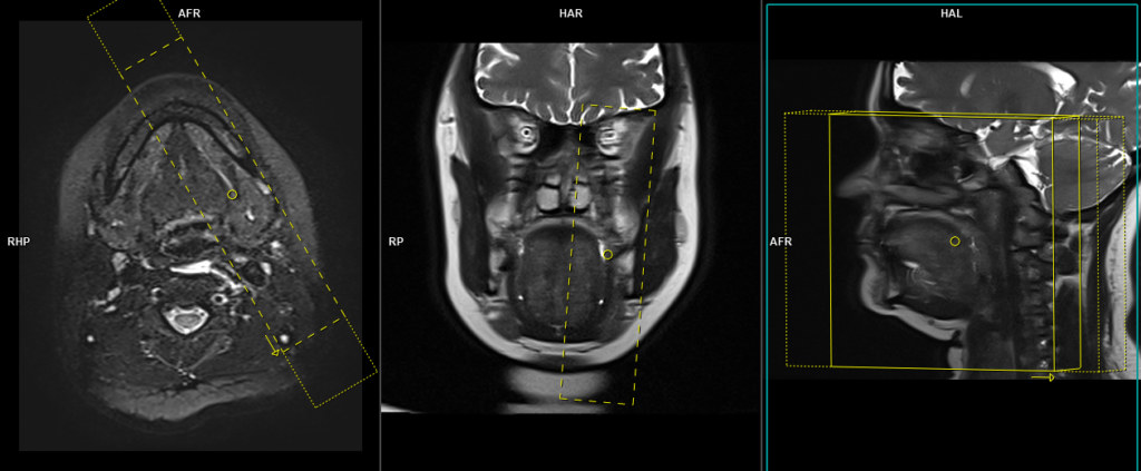 MRI submandibular sialography sagittal haste scan protocol and planning for 60mm scan